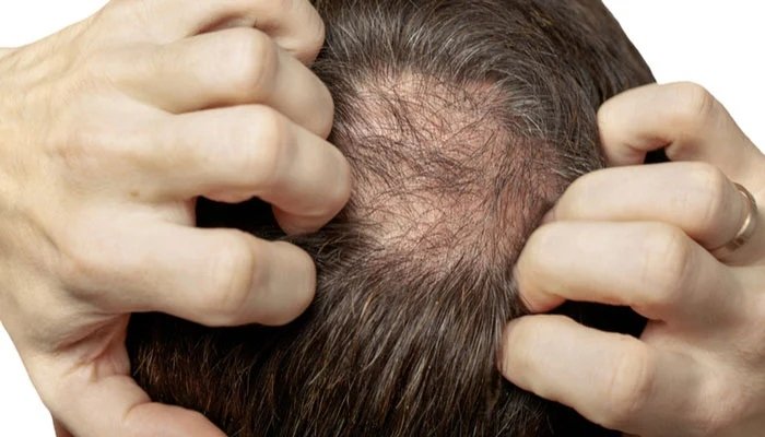 Sudden hair loss