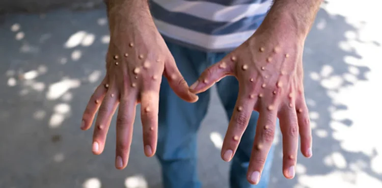 Monkeypox spread in Karachi